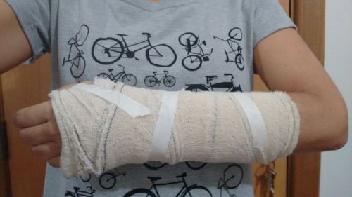 o braço quebrado de minha amiga.